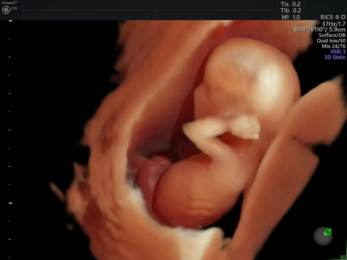 ЭКО после 50: возможно ли материнство в зрелом возрасте?