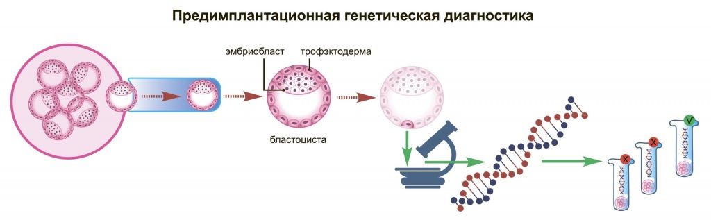 Вторичное бесплодие