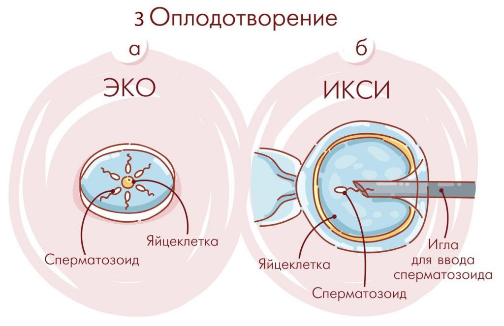 Вторичное бесплодие